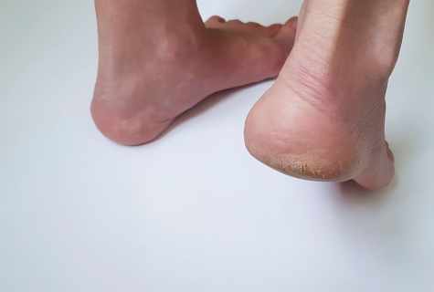 How to remove callosities on heels
